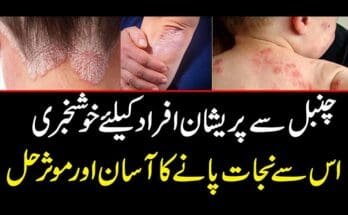 Home-Remedies-to-Get-Rid-of-Psoriasis