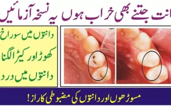Tooth-Decay-Prevent-Gum-Disease