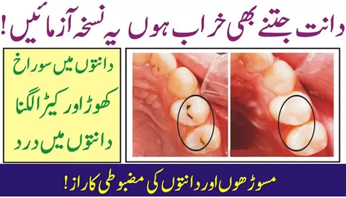 Tooth-Decay-Prevent-Gum-Disease